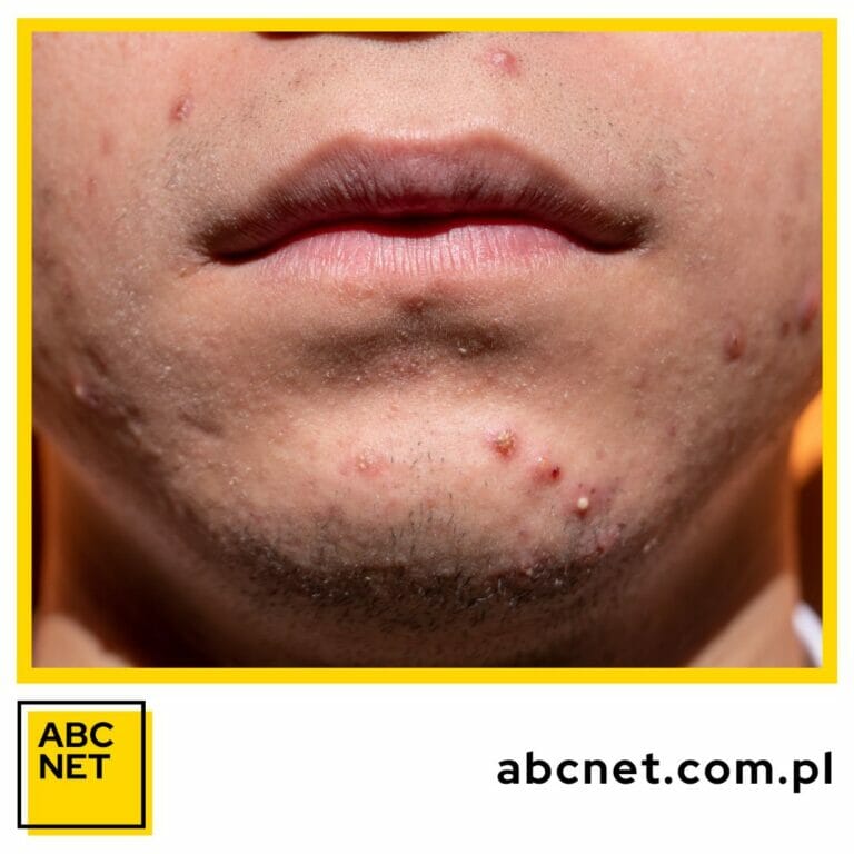 dieta na trądzik. co to jest dieta na trądzik