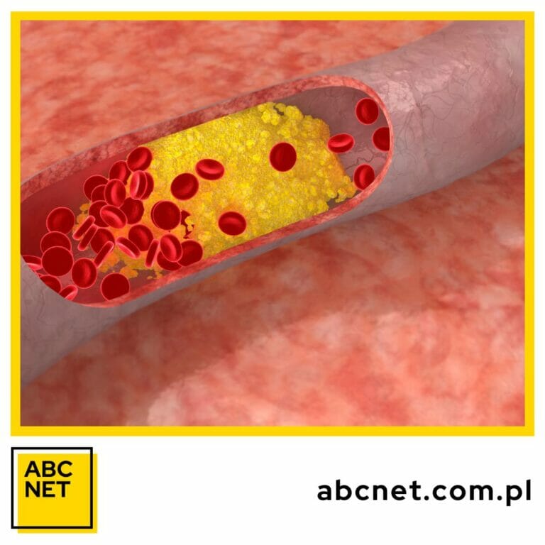 dieta na wysoki cholesterol