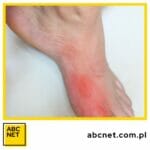 dieta zapobiegająca dnie moczanowej