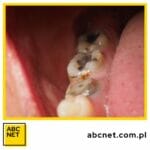 dieta zapobiegająca próchnicy