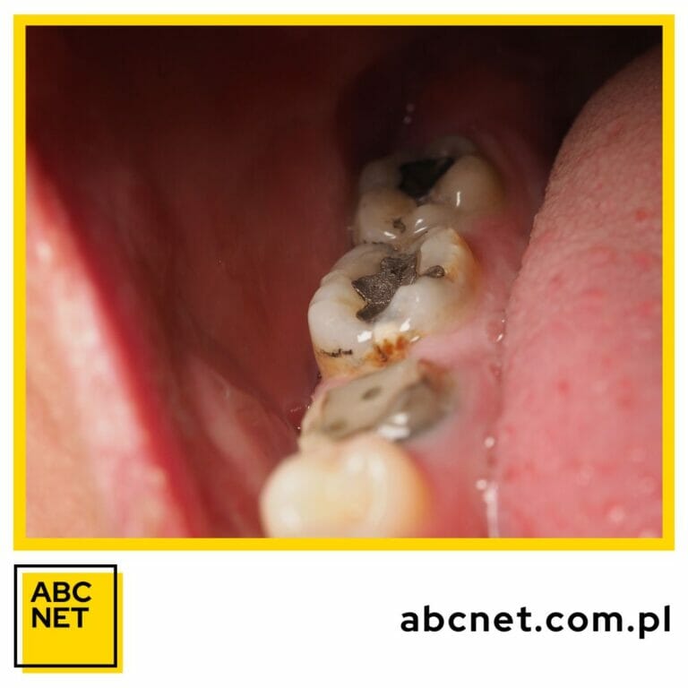 dieta zapobiegająca próchnicy