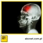 dieta zapobiegająca udarowi mózgu