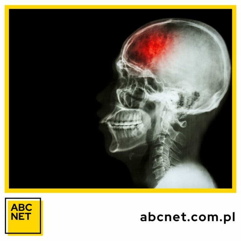 dieta zapobiegająca udarowi mózgu