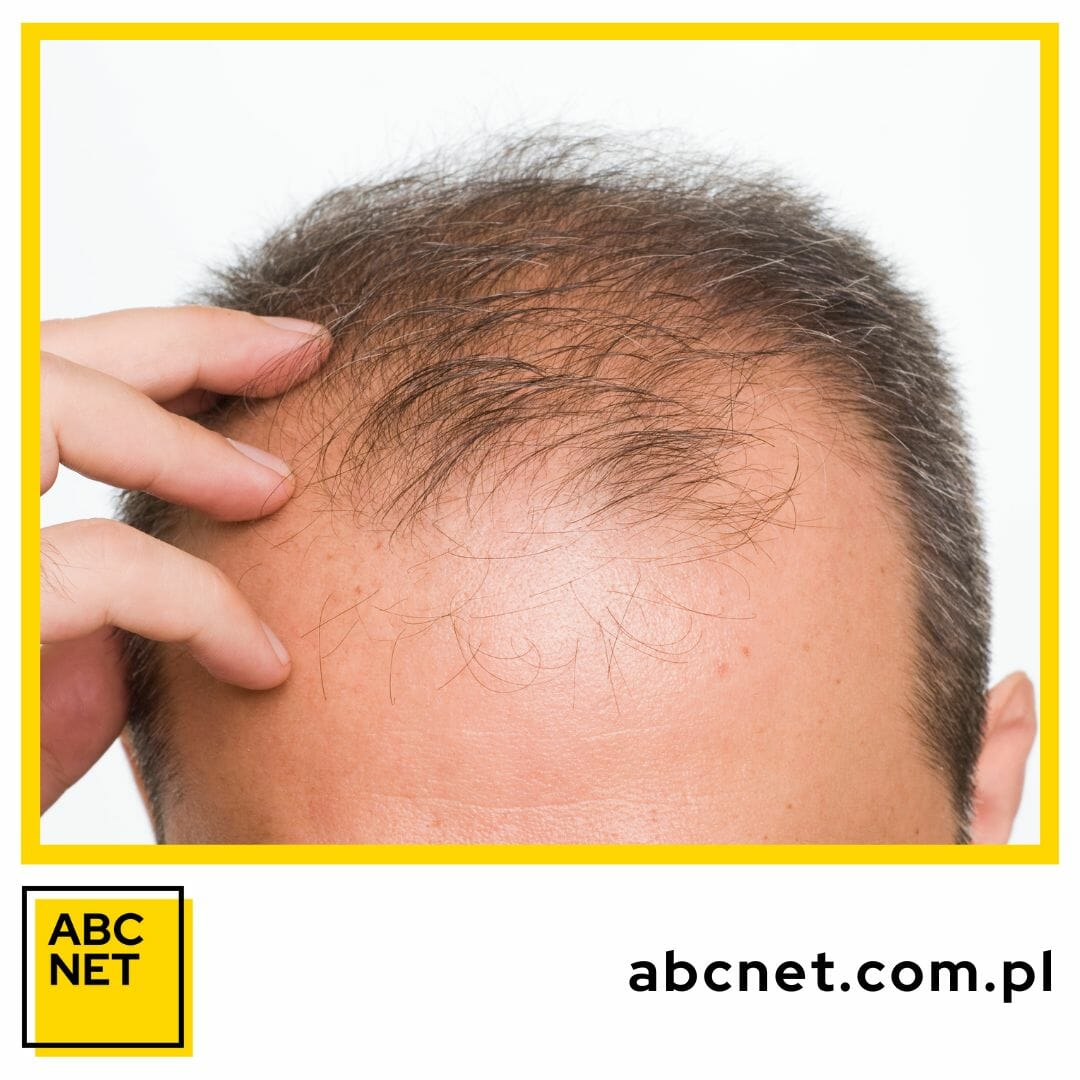 dieta zapobiegająca wypadaniu włosów