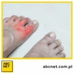 dna moczanowa dieta. co to jest dna moczanowa dieta