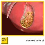 woreczek Żółciowy dieta. jaka dieta na woreczek żółciowy